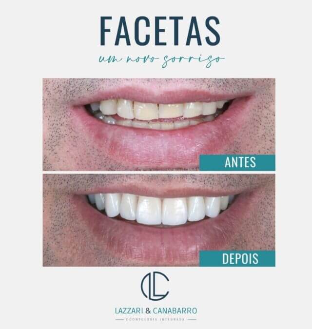 FACETAS