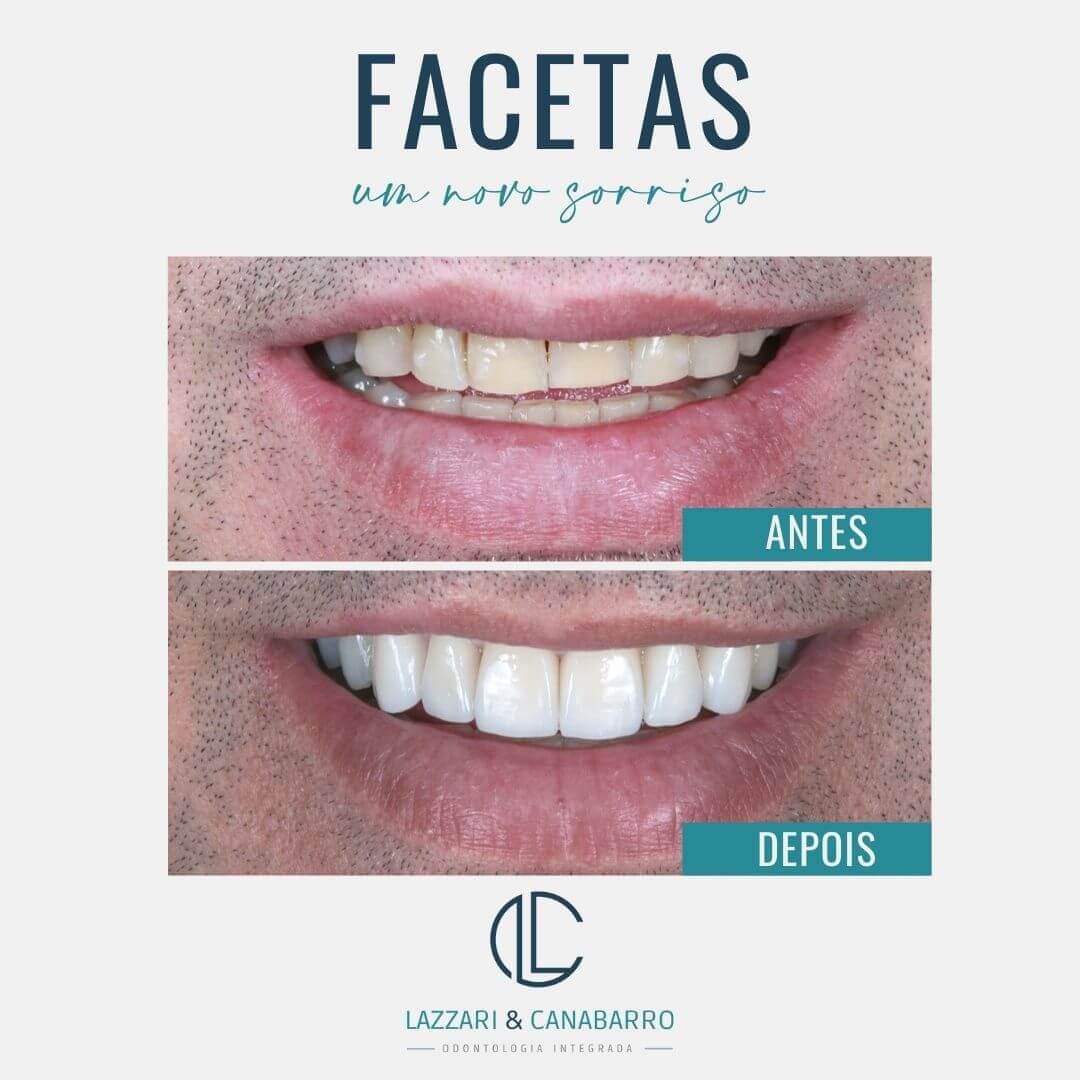 FACETAS