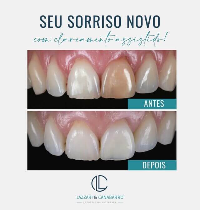 SEU SORRISO NOVO: COM CLAREAMENTO ASSISTIDO