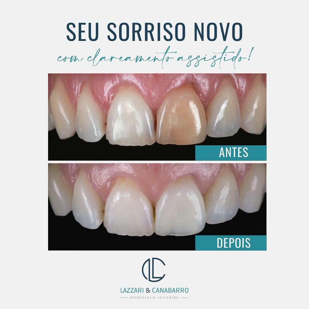 SEU SORRISO NOVO: COM CLAREAMENTO ASSISTIDO