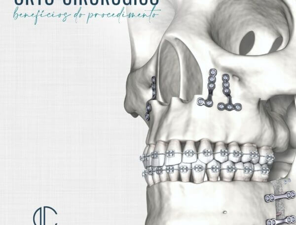 ORTO- CIRÚRGICO: BENEFÍCIOS DO PROCEDIMENTO