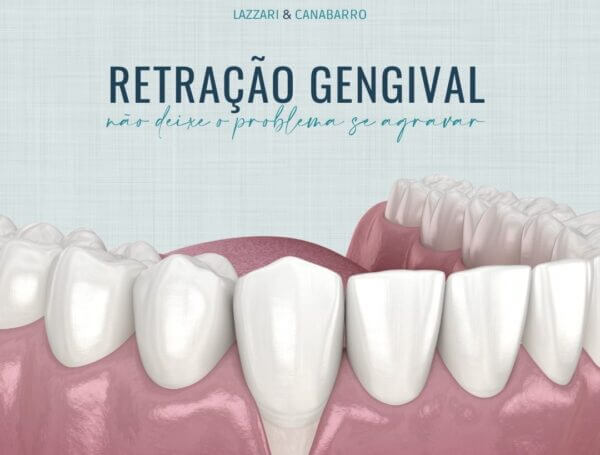 RETRAÇÃO GENGIVAL