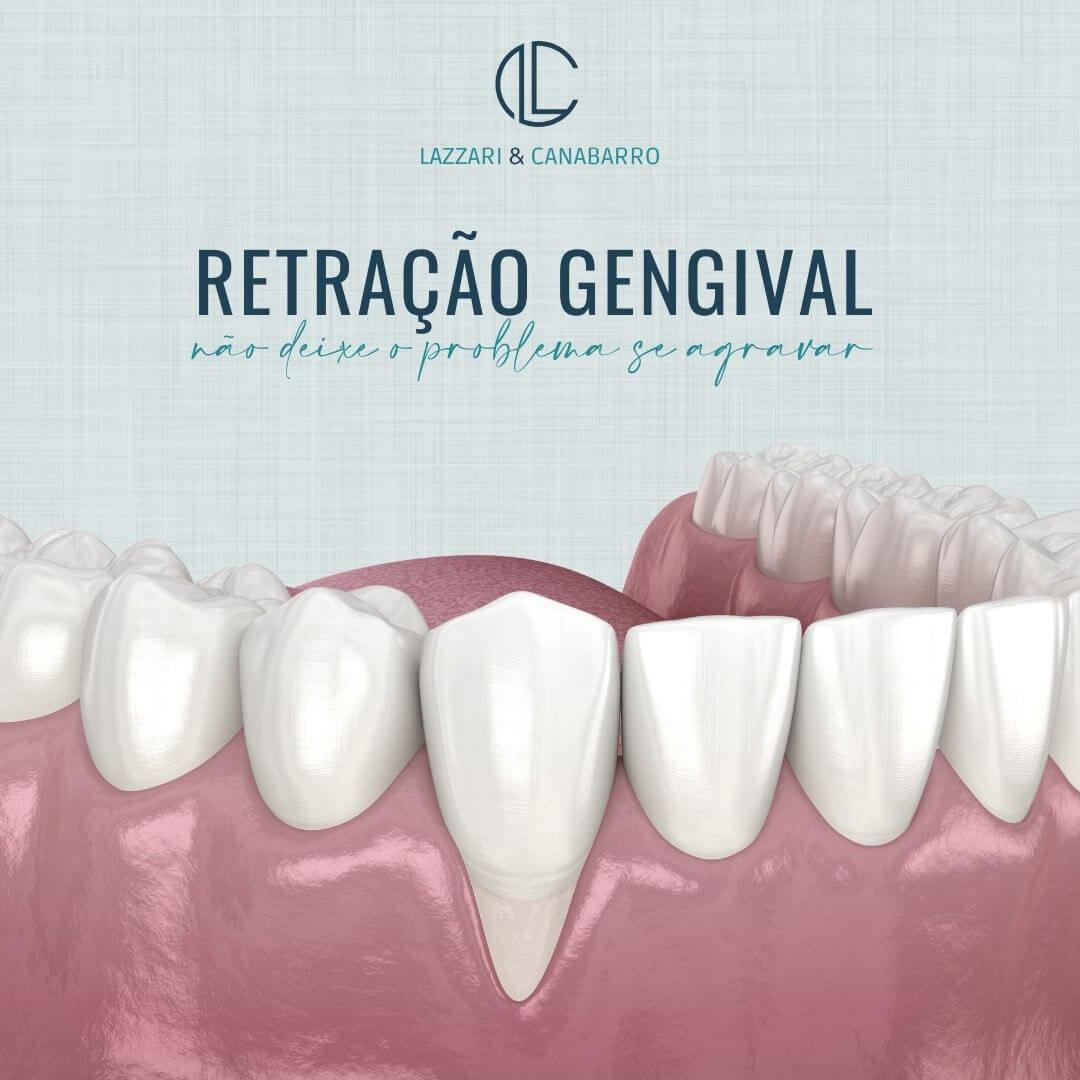 RETRAÇÃO GENGIVAL